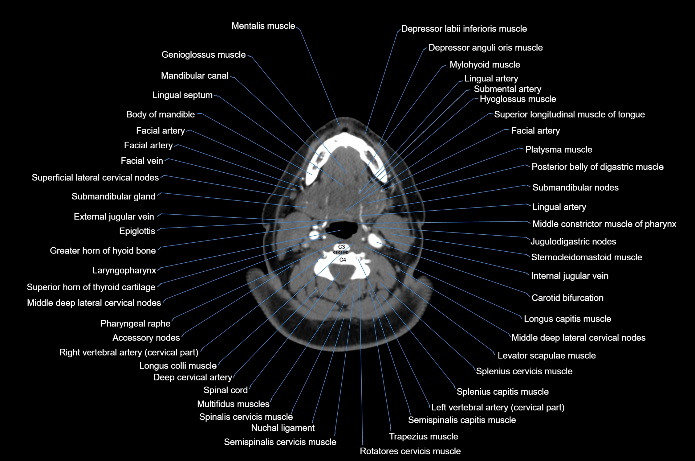 CT Neck axial cross sectional anatomy radiology image-img-00001-00036.webp
